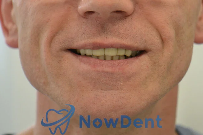 Ładny naturalny męski uśmiech Estetyczny efekt rekonstrukcji zębów z zachowaniem naturalnych męskich cech uśmiechu – NowDent Chorzów