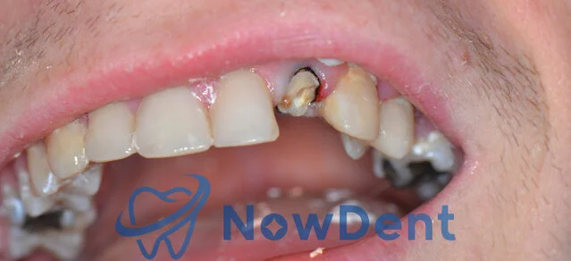 Całkowicie uszkodzony ząb przedni przed leczeniem protetycznym, dentysta Chorzów