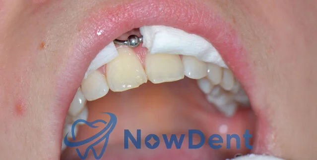 Stan przed estetyczną odbudową kąta siecznego - NowDent Chorzów
