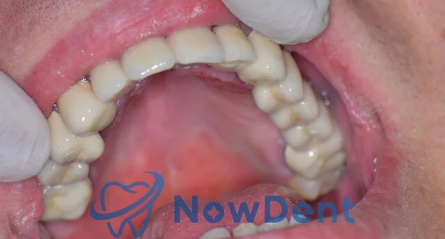 Odbudowa braków zębowych za pomocą mostu protetycznego, stomatologia NowDent Chorzów