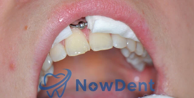 Stan przed estetyczną odbudową kąta siecznego - NowDent Chorzów